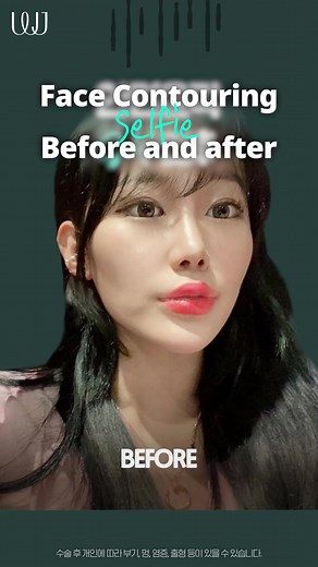 2.1K views | Facial Contouring before &after - WJ ✨️ Over 20 years...