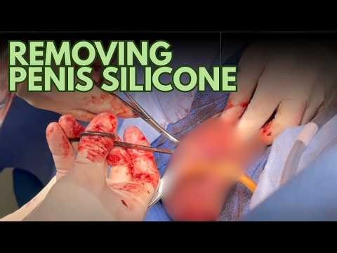 Graphic Surgical Procedure - Penis Silicone Removal
