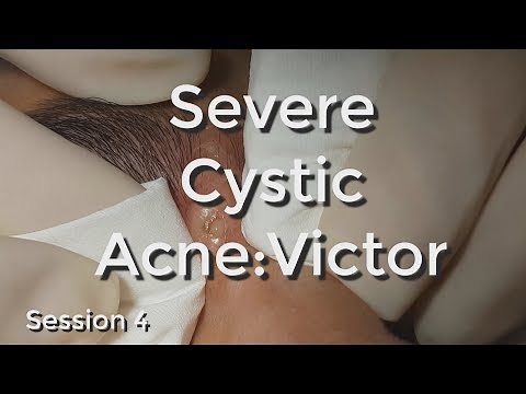 Severe Cystic Acne - Victor: Session #4