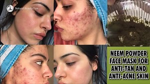 NEEM POWDER FACE MASK FOR ANTI-TAN AND ANTI-ACNE SKIN | Tips of top beauty experts