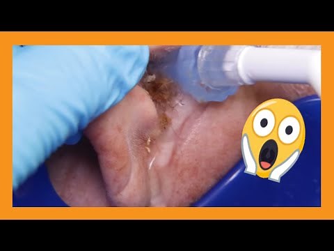 Blocked Ear Cleaning Marathon | Auburn Medical Group