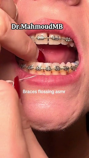 Flossing with Braces: Yes, You Can!