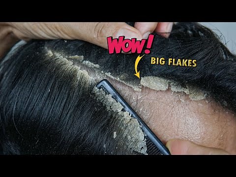 Itchy Dry Scalp Big Dandruff Scratching #1185