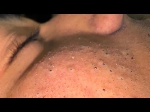 Pore Strip Alternative: Clay Mask for Blackhead Removal