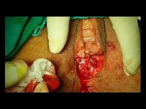 Transperineal Repair of 3rd Degree Tear & Anterior Rectocele + Complete Perineal Body Reconstruction