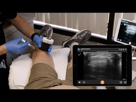 Intra-articular Hyaluronic Acid Injection