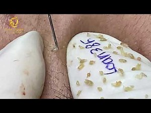 Best blackheads removal (385) | Loan Nguyen