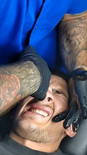 This video shows a practitioner attempting to realign a deviated septum using only manual manipulation—a method that sparks curiosity and controversy. While some claim that nasal adjustments have been practiced for centuries in alternative medicine and osteopathy, modern medical science does not officially recognize this as a proven treatment for deviated septums. 👉 Historically, manual nose adjustments have been seen in ancient osteopathic techniques, traditional Asian medicine, and even early