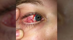 A woman has accused a suburban doctor of operating on the wrong eye- and she says things only got worse from there. That and more in today's rundown: http://nbcchi.com/usRVaRZ | NBC Chicago