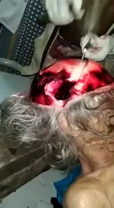 Head Autopsy Using a Hammer