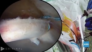 Left Hip Arthroscopy & Labral Repair