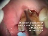 Treatment Of Furcation Caries • Video • MEDtube.net