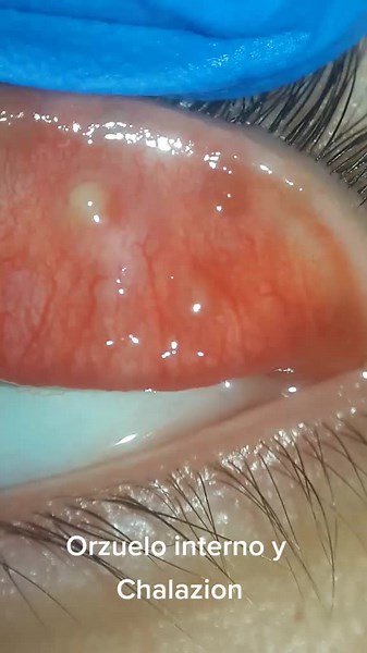 Understanding Inner Swelling and Chalazion in Eyes