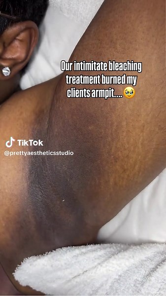 Not literally but figuratively 😮‍💨. Our intimate bleaching services can be done anywhere on the body to lighten pigmented areas other than your face. If you deal with discoloration in the Anal, Brazillian, inner thighs, elbows, etc then this is for you 😊. Book your multiple sessions now to get started! We offer full body waxing and corrective skincare services! You can schedule today online or by calling us! 💻 PRETTYAESTHETICSSTUDIO.COM 📍WACO 76704 TUES 📍DFW 75243 MON,WED-SAT #dfwesthetici