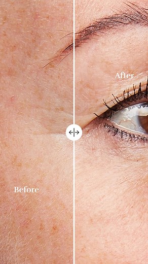 Amazing results using our FaceTite Mini. Treatment on a female age 52: 15 minutes per zone, 3 times a week for 12 weeks. What area would you treat with FaceTite mini? #silkn #facetite #beforeafter | Silk'n