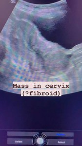 Cervical mass #fibroids #fibroid #cervixcancerawarenes #cervicalcancer #cervicalmass #gynaecologyultrasound #absominalultrasound #abdominalultrasound #cervixpathology #uterinefibroid #ultrasoundmadeeasy | Ultrasound made easy