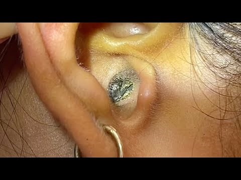 Ear Cleaning Episode [EP:07] | Safe Ear Wax Removal & Hygiene Tips for Healthy Ears 👂✨