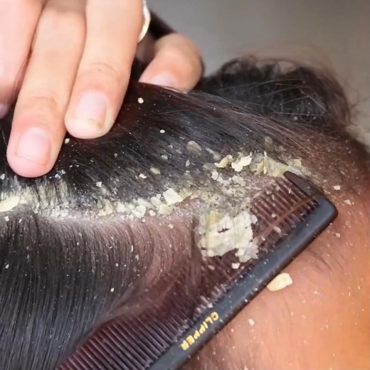 ICHY DRY SCALP _ SCRATCHING DANDRUFF IN HAIR _ REMOVAL HUGE FLAKE #HugePsoriasis #FlakesScratchingSatisfying #Dandruff Worm #HUGE FLAKE #DandruffBigFlakes #dandruffremoval #dandruffshampoo #dandruffproblems #dandrufftreatment | FreeQgame