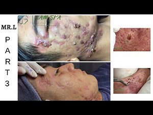 [Mr.L Part 3] Treatment of acne pustules, severe inflammation | Điều trị mụn mủ viêm nặng | LAMSPA