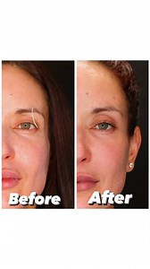 ✨Temple & Forehead Fillers ✨ Filler is injected to plump up the depressions in the forehead. This will give a smooth, rounded, youthful contour to the forehead. This creates an ultra- feminine upper face and subtle lift in the brows. The loss of volume in the #temples can have a big impact on the rest of the face. By targeting temple hollows with a filler, patients can achieve a lifted appearance in a non-surgical way. It’s like having a #minifacelift, without the need for scalpels. • • To sched