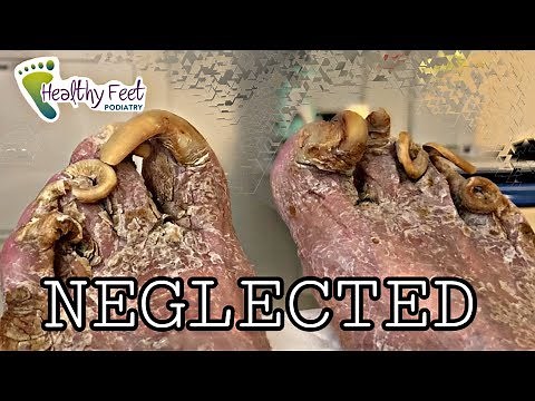 Cutting Neglected Nails, EXTREME THICK TOENAILS