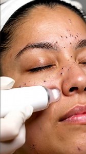 Watch These Cheek Blackheads Disappear One by One 😱
