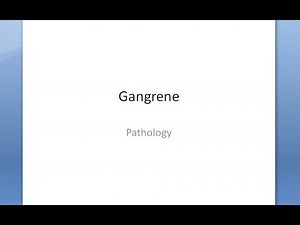 Pathology 049 a Gangrene Types Dry Wet Gas Gangrene Diabetic foot Bed Sore