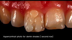 94K views · 397 reactions | Composite buttons by our friend Dr. Serhat Köken | ZERODONTO | Facebook