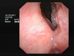 Cancer of the larynx (voicebox) - www.drjeeve.com