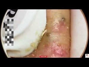 Massive Blackheads Removed! – Extremely Satisfying Extraction
