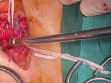 Subclavian to Carotid Bypass in Patient with Carotid Extensive Dissection  • Video • MEDtube.net