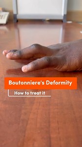 3.8K views · 45 reactions | Boutonnière’s deformity is a condition...