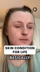 2.5K views | Raw, real, and powerful — she opens up about the highs, lows, and everything in between on her journey through Topical Steroid Withdrawal (TSW). From painful flare-ups to moments of healing, this is more than skincare — it’s survival, strength, and self-love. ❤️ #TSWJourney #TopicalSteroidWithdrawal #SkinHealing #RealTalk #ChronicSkinWarrior | Awesome Videos | Facebook