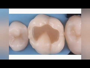 Composite restoration of dental anatomy. Step-by-step restoration teeth