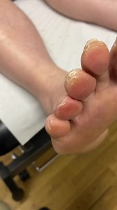 1.1K views | Satisfying tip / apex of toe callus removal by australian . Podiatrist with a scalpel. Pressure causes the skin to harden and corns and callus to form #cornn# #callus #poditrist #australia #ergonx #docpods | Piesperfectosmx | Facebook