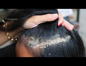 Dandruff Satisfying Removal Biggest Worms On Ranking Scalp #dandruffremoval #dandruffshampoo #dandruffproblems #dandrufftreatment | FreeQgame