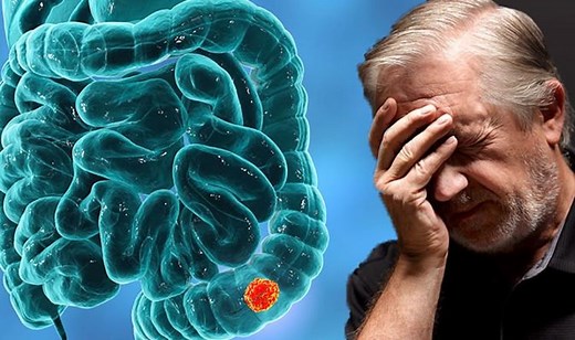 Bowel cancer: Signs and symptoms to look out for