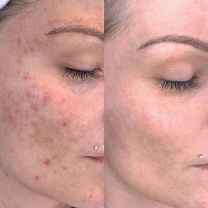 Microneedling to treat wrinkles on hand Anti-Wrinkle & Anti-sagging Combined Protocol This treatment is efficient, non-invasive, safe and quick result oriented signature at Royal Retreat Spa it is now used for BODY & FACE including: 📍#wrinkles 📍#acne 📍#enlarged pores 📍#scars of any kind 📍#stretch-marks 📍loose skin on chin, tummy, jaw 📍#alopecia 📍#hyperpigmentation 📍#dehydrated-skin and more... #Plasma-jet help to tighten the skin and create lift on loosen skin in any area of body. It ca