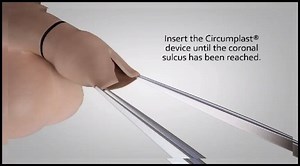 circumcision style Tight with frenulum Removal Full Video Here >> https://goo.gl/UkJfvd _____________________________________ For more Videos Join Us on Youtube Subscribe Here : https://goo.gl/bbOmKY | Pediatric urology