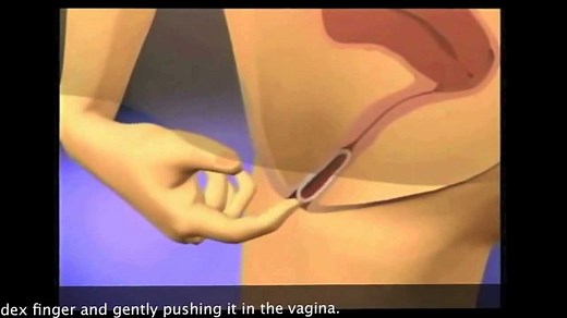 How to Use NuvaRing - How To Insert Nuvaring