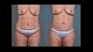 Learn About Tummy Tuck Scar Placement and Healing