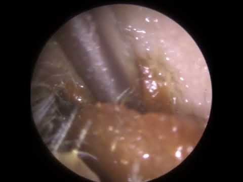 827 - Extra Large Ear Wax Removal