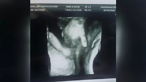 Sonogram shows dying twin holding unborn sister's hand
