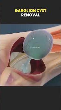 Ganglion Cyst Removal Surgery (3D Animation) #ganglioncyst #ganglioncystremoval #cystremoval #wrist