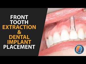 Front Tooth Extraction and Dental Implant Placement