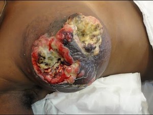 I Thought It Was A Sebaceous Cyst... It Wasn't! Cysts, Boils, Tumors and Lipomas!