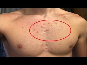 how to get rid of chest acne scars fast