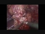 Laparoscopic Left Partial Nephrectomy • Video • MEDtube.net
