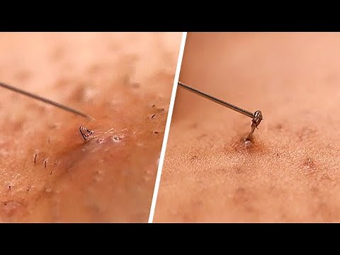Ingrown Hair Removal Guide | Beauty Studio