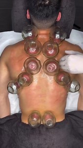 🔥 Fire cupping uses heat to create a negative pressure (vacuum) inside glass or bamboo cups. A flame is quickly introduced into the cup to heat the air, then removed immediately before placing the cup on the skin. As the air inside the cup cools rapidly, it contracts—this creates a suction effect that draws the skin and superficial muscle layer into the cup. Note: We do not perform fire cupping at our office—this post is for educational purposes only. #FireCupping #MyofascialRelease #Chiropract
